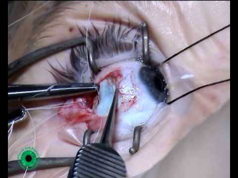 جراحی انحراف چشم