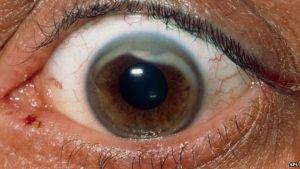 التهاب قرنیه چشم