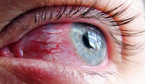 درمان التهاب چشم