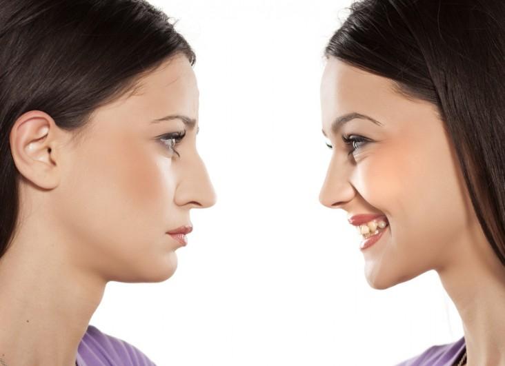 فواید عمل بینی استخوانی
