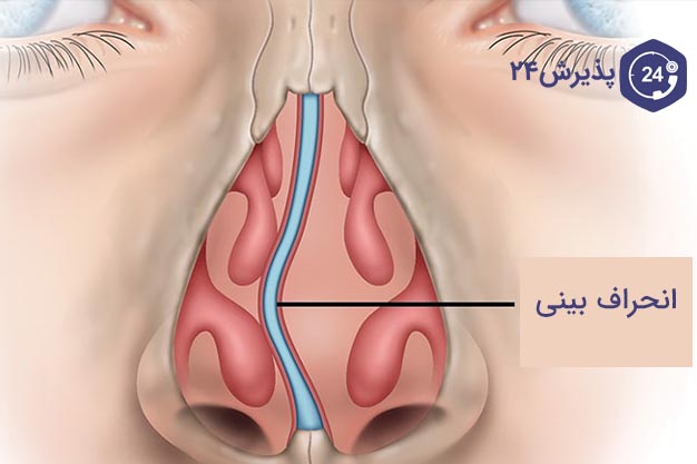 انحراف بینی