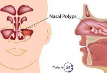درمان پولیپ بینی