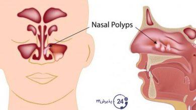 درمان پولیپ بینی