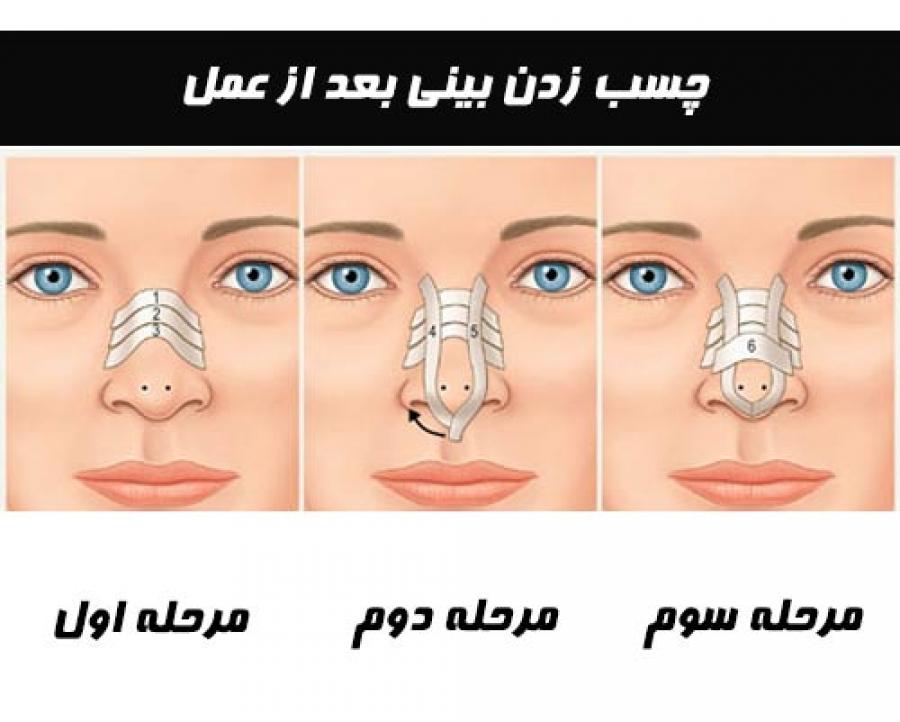 نحوه صحیح چسب زدن بینی 