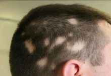 ریزش مو آره آتا یا آلوپسی آره آتا مدل دیگری از ریزش مو است که هرچند نسبت به مدل‌هایی مثل ریزش مو تلوژن افلوویوم و ریزش موی آندروژنیک، رواج کمتری دارد اما مقابله با آن، مستلزم دخالت فوری یک متخصص پوست است. این همان مدلی است که با نام طاسی سکه‌ای یا ریزش موی سکه‌ای نیز شناخته می‌شود.