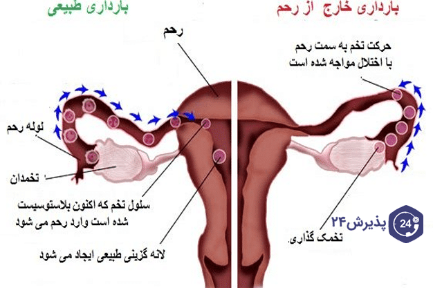 حاملگی خارج رحمی