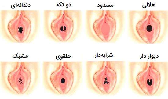 انواع پرده بکارت دختران