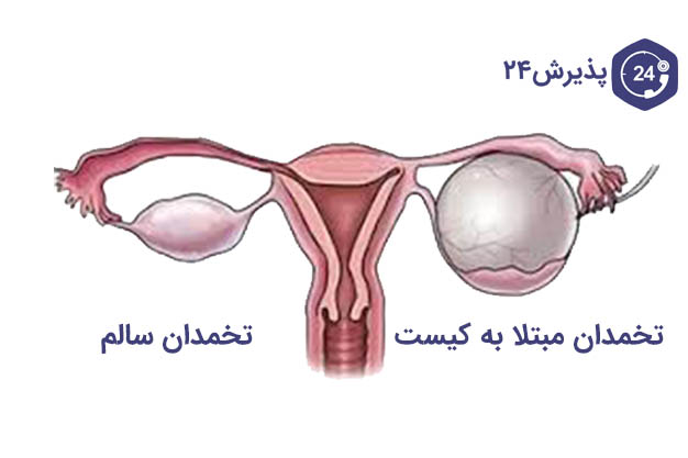 تفاوت تخمدان سالم و دارای کیست