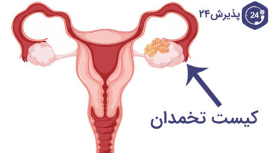 عکس کیست تخمدان