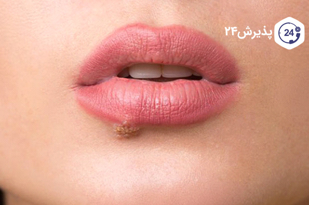 زگیل روی صورت نشانه چیست؟