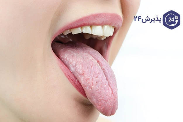 علائم خشکی دهان