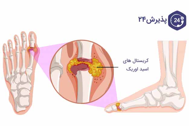 علل روماتیسم
