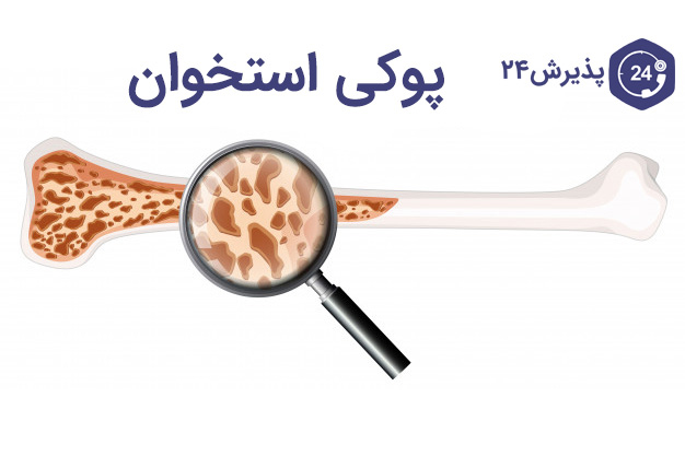 پوکی استخوان