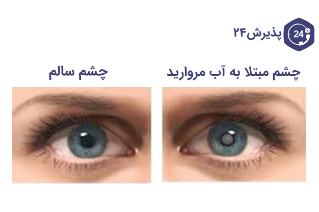 چشم مبتلا به اب مروارید