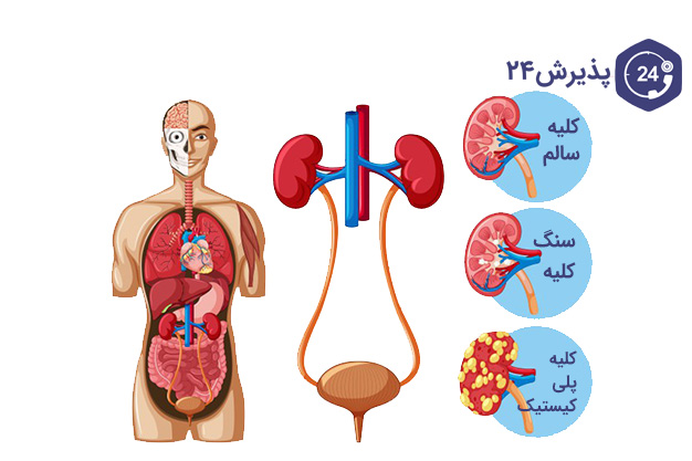 انواع سنگ کلیه