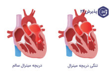 تنگی دریچه میترال