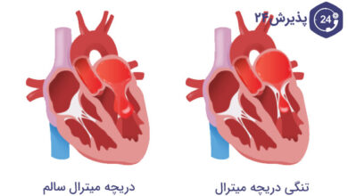 تنگی دریچه میترال