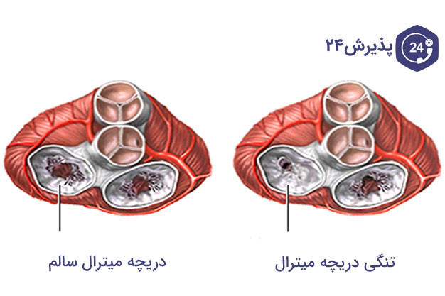 دریچه میترال سالم و تنگی دریچه میترال