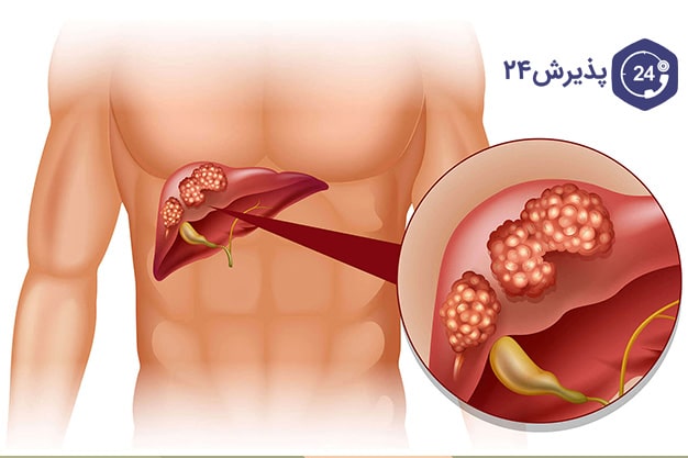 علت سرطان کبد