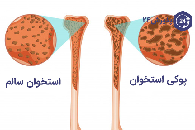 مقایسه استخوان سالم و پوک