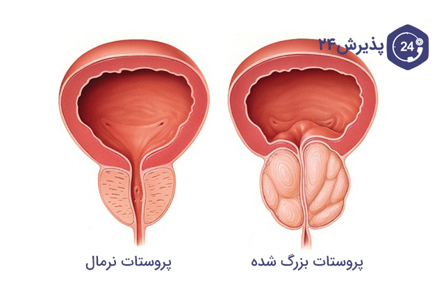 پروستات نرمال و بزرگ شده