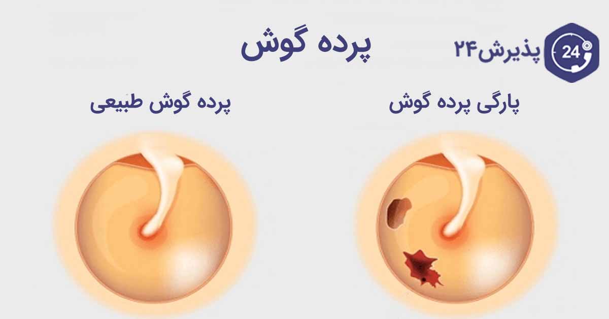 پرده گوش