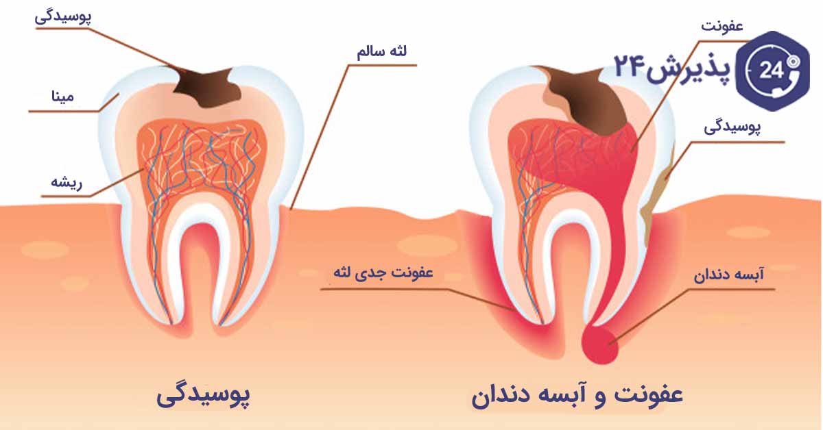 تفاوت عفونت با آبسه دندان
