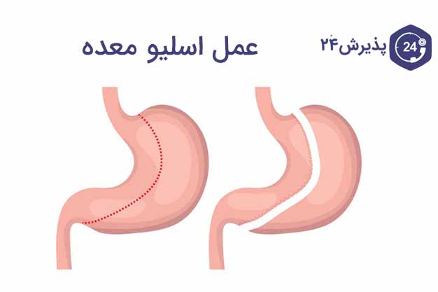 عمل اسلیو معده