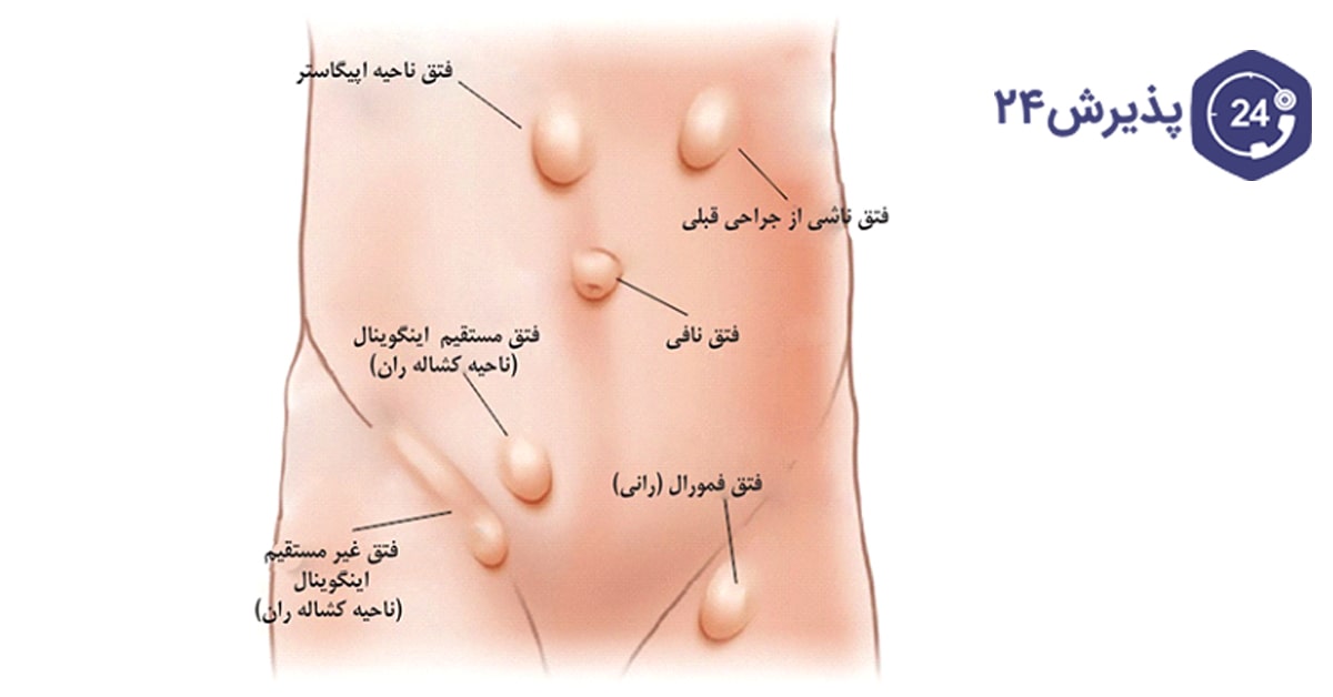 فتق شکم