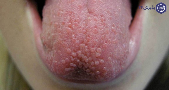 علائم HPV اچ پی وی دهانی چیست؟