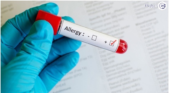 آزمایش آلرژی