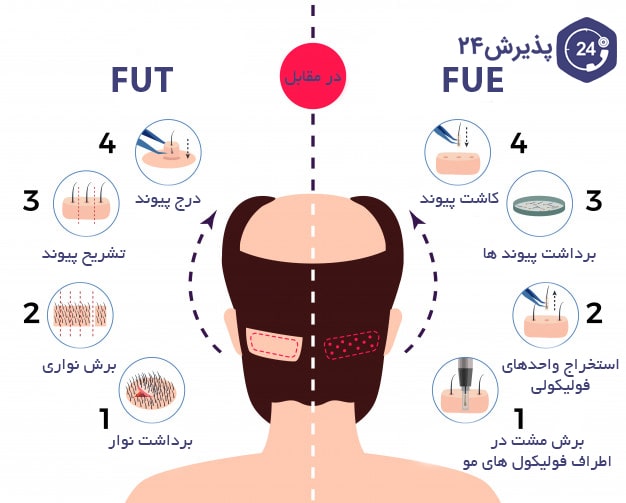 کاشت مو با چه روشی بهتر است