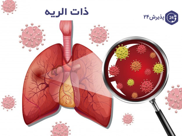 بیماری سینه پهلو یا ذات الریه | علائم، راه‌های درمان و پیشگیری