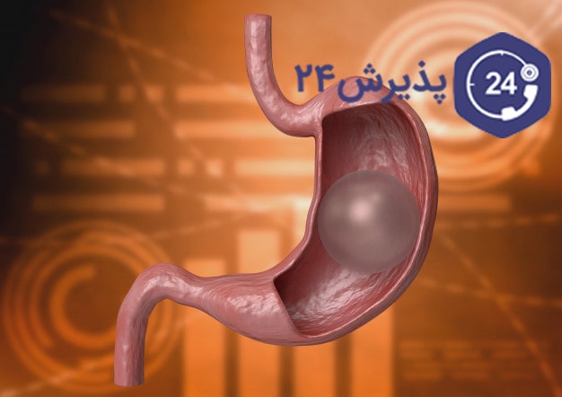 عمل بالن معده| انواع، مزایا و معایب