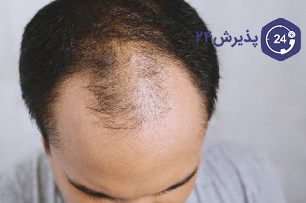کاشت مو چیست؟ | بهترین روش :{