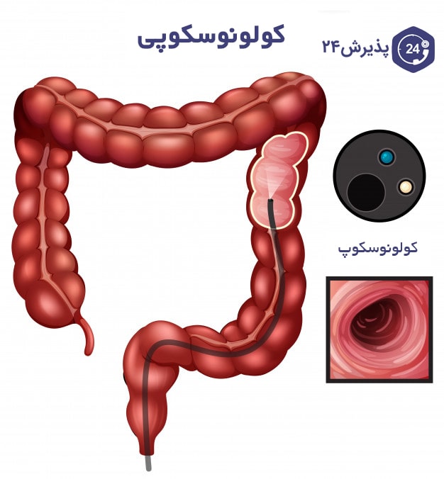 پولیپ روده | علائم و درمان خانگی و دارویی