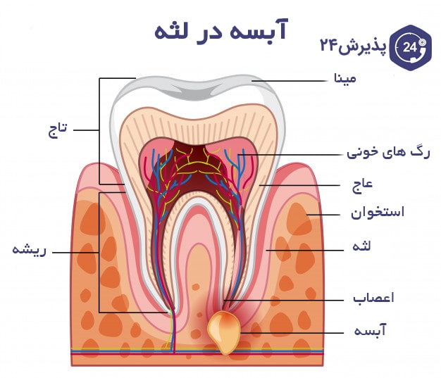 عفونت لثه | علائم، علل ابتلا و راه های درمان