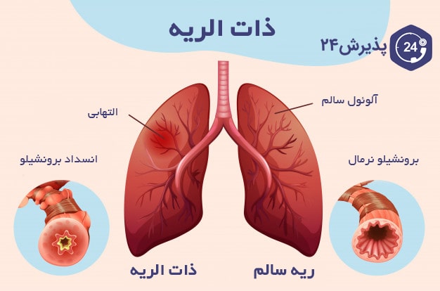 بیماری سینه پهلو یا ذات الریه | علائم، راه‌های درمان و پیشگیری