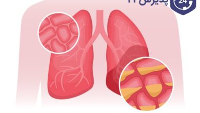 بیماری سینه پهلو یا ذات الریه | علائم، راه‌های درمان و پیشگیری