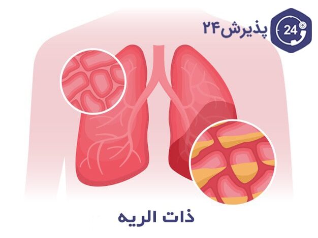 بیماری سینه پهلو یا ذات الریه | علائم، راه‌های درمان و پیشگیری