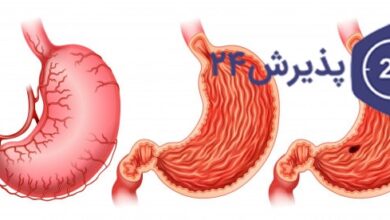 زخم اثنی عشر| علائم، درمان و پیشگیری