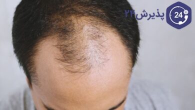 کاشت مو چیست؟ | بهترین روش های کاشت مو، مزایا و عوارض کاشت مو