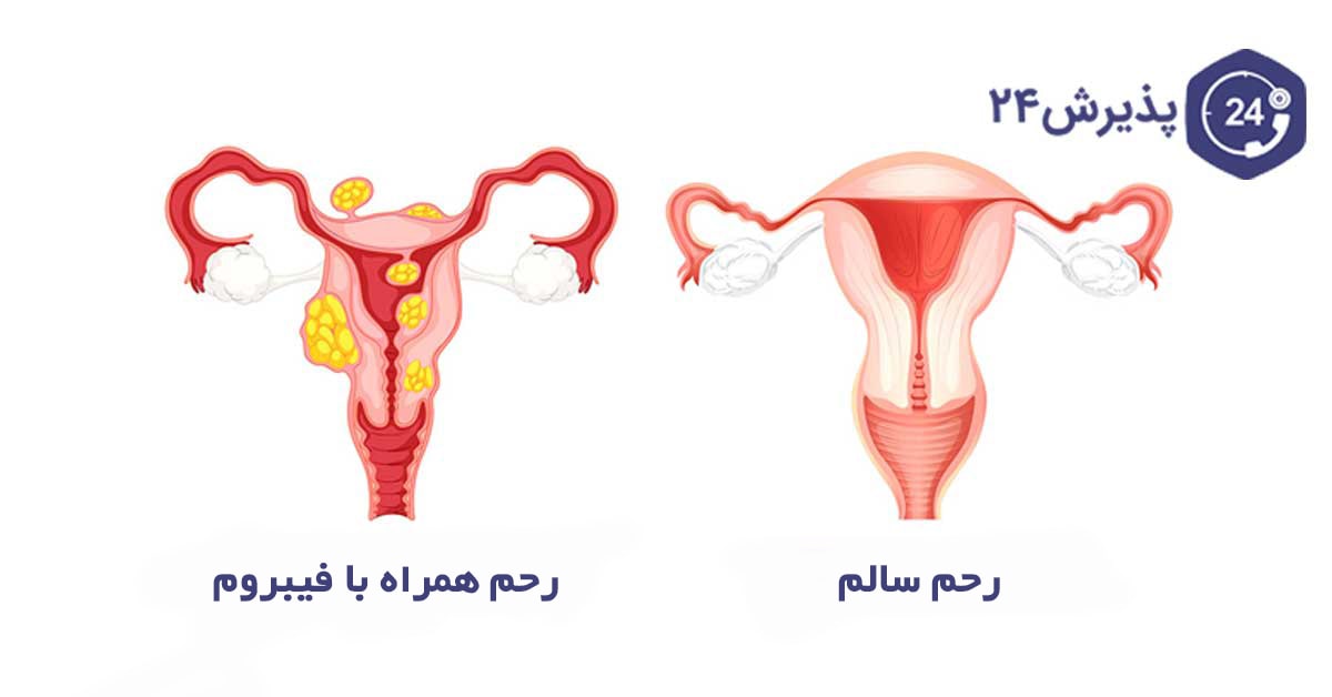 دلایل ایجاد فیبروم رحم چیست؟ و راه های درمان آن