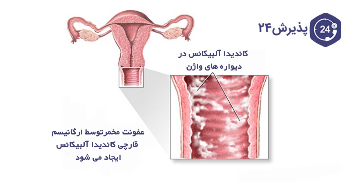 عفونت قارچی واژن چیست؟علائم و روش های درمان گیاهی و دارویی آن