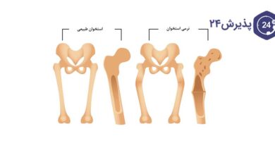 نرمی استخوان چیست