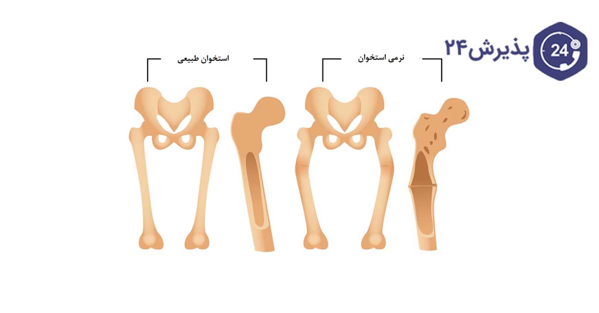 نرمی استخوان چیست
