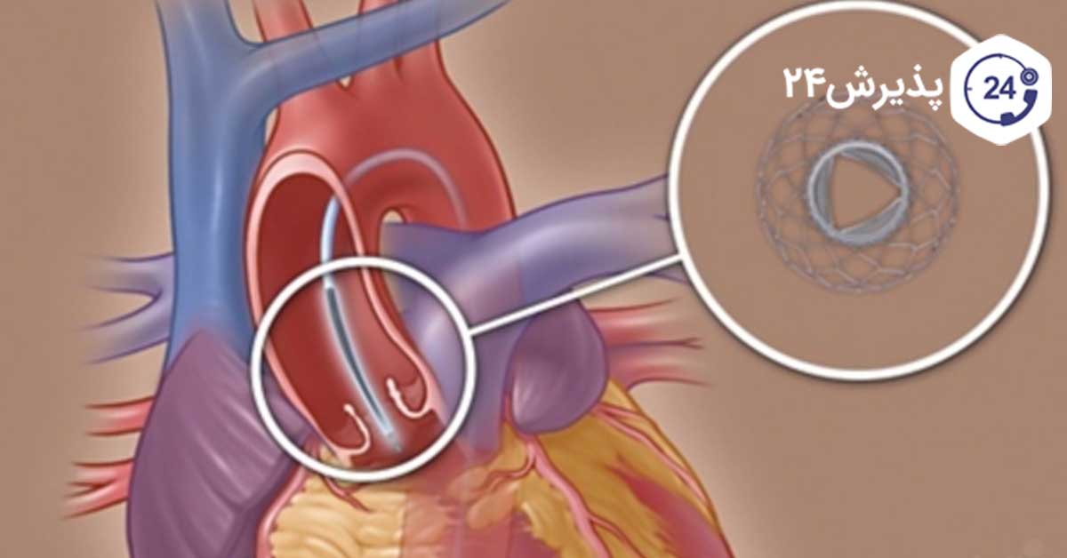 دریچه آئورت درون حلقه مشخص شده است.