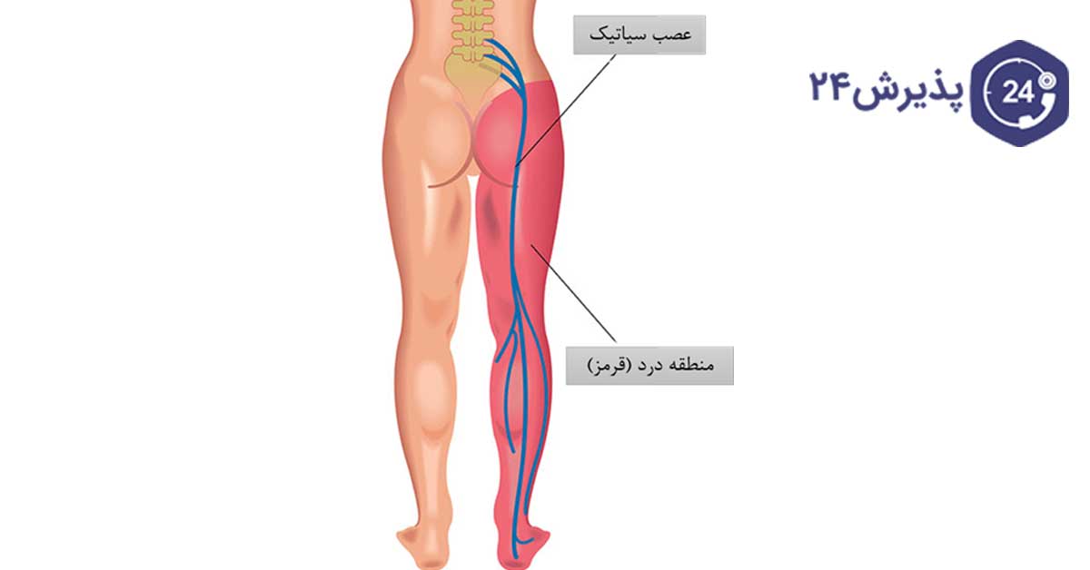 در تصویر ناحیه‌ای که با سیاتیک آسیب‌دیده درد خواهد داشت را مشاهده می‌کنید.