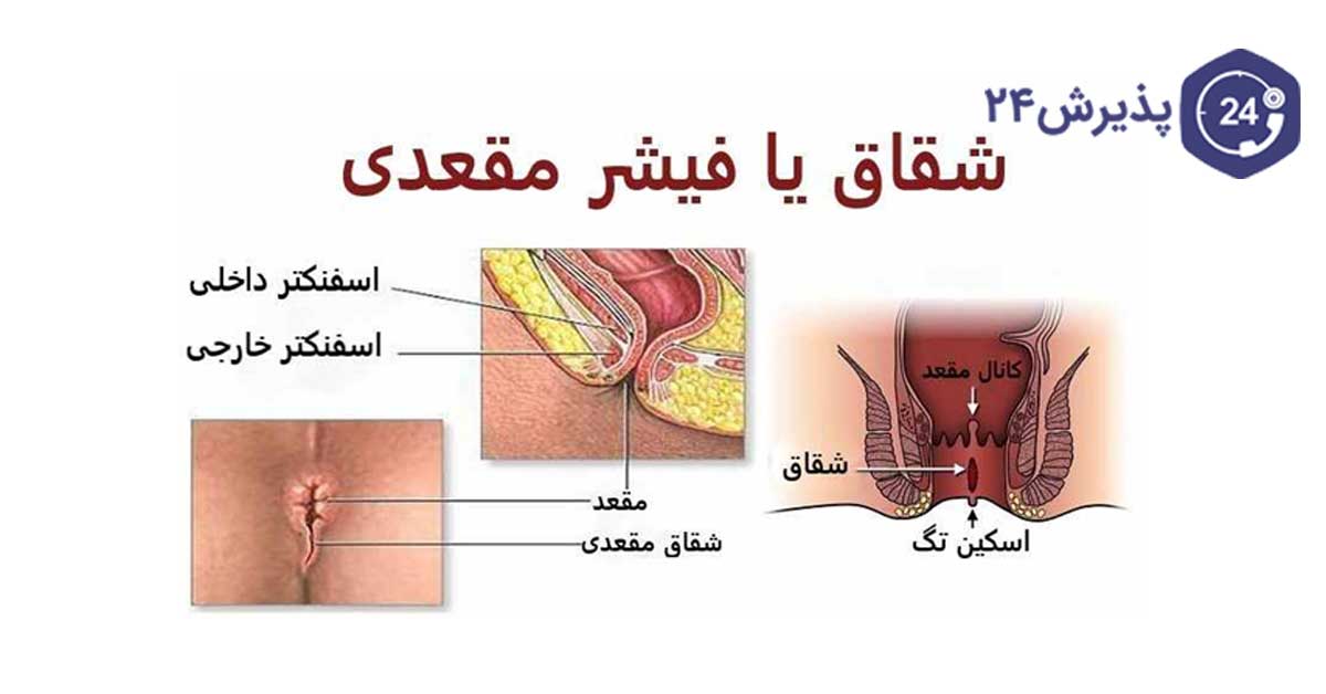 شقاق و علائم آن