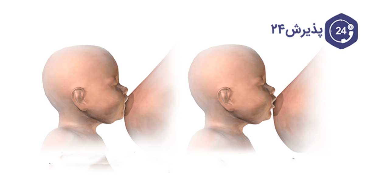 میزان شیردهی به نوزاد